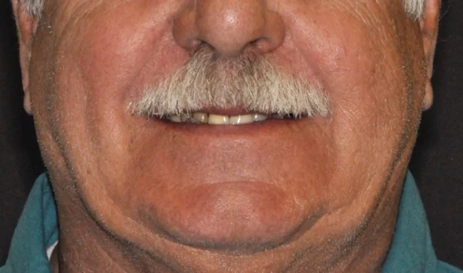 Implant-assisted partial: the patient's smile before treatment.